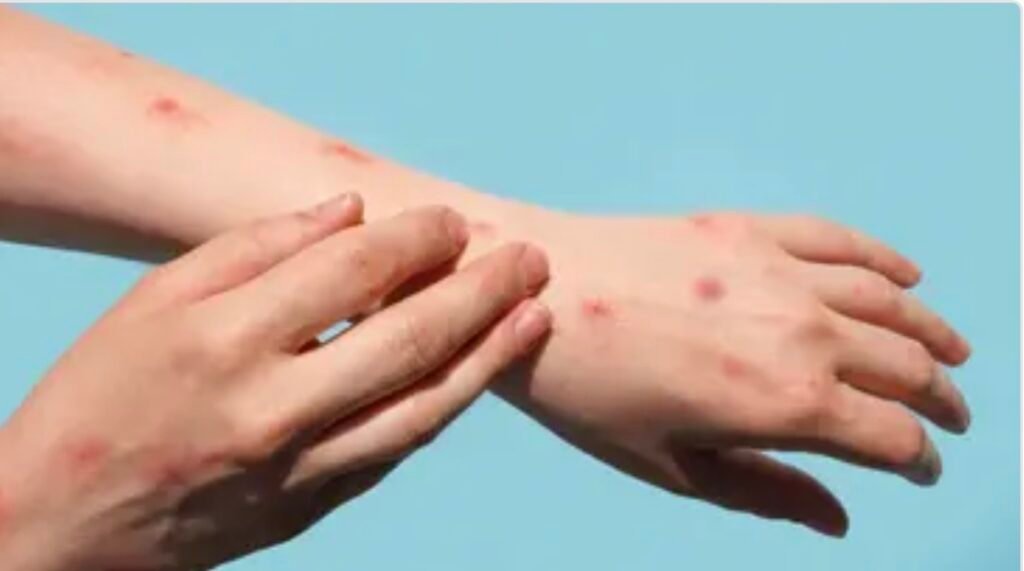 **India Reports Monkeypox Case in Traveler from Outbreak Country**
